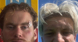 Brotnar framtennur og skurður þegar Þorleifur og...